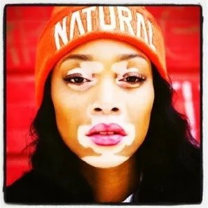 Je vis ma vie avec le #vitiligo