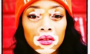 Je vis ma vie avec le #vitiligo