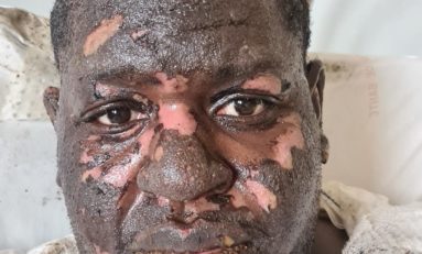 Le brûlé d’ALBIOMA